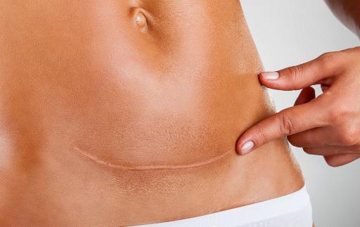 剖腹产的伤口，我该拿你怎么办