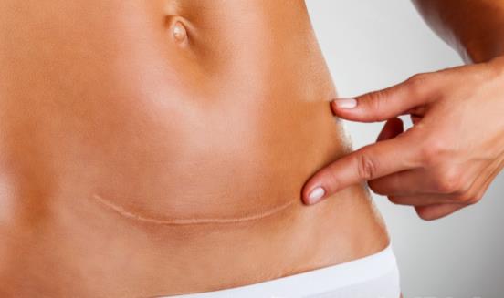 细数剖腹产的七大危害 剖腹产坐月子注意事项-八凡集