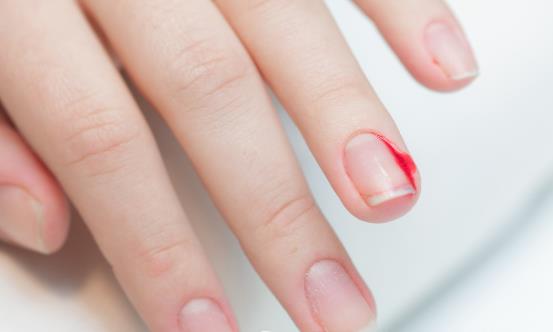 倒刺虽小处理不好会出大问题 预防倒刺有妙招-八凡集