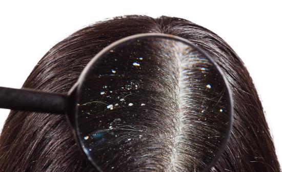 头皮屑多是什么原因引起的 推荐6个有效去除头皮屑的小妙招-八凡集