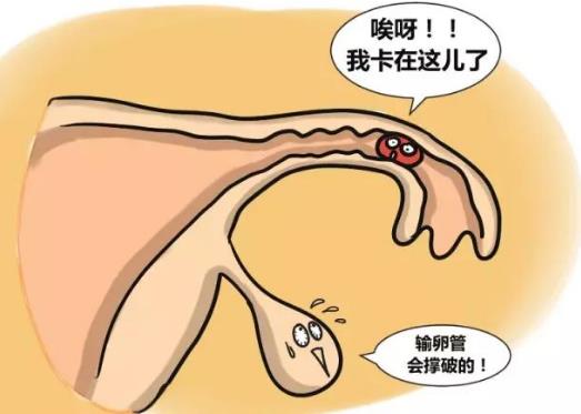 输卵管妊娠的自我检查、症状及治疗方法-八凡集