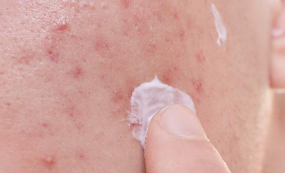 血热体质火气上升烦躁 调理血热多喝点菊花水-八凡集