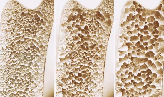 骨质疏松的10个认知误区,你中了没?