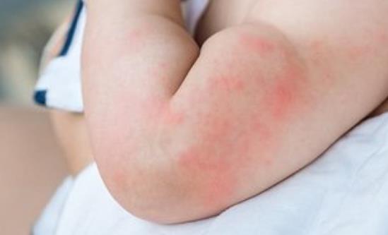 荨麻疹影响生活工作 荨麻疹的治疗方法-八凡集
