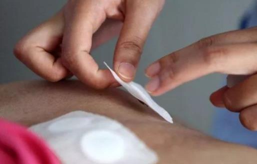 儿童三伏贴贴满三年还要贴吗 三伏贴儿童几岁可以贴