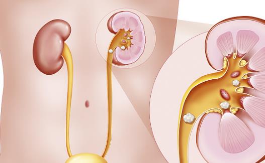 肾结石出现的六大原因 预防肾结石复发的饮食调理-八凡集