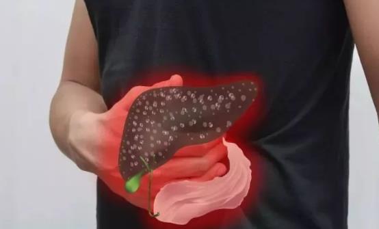 治疗黄疸型肝炎的9则小偏方 能有效治疗黄疸型肝炎-八凡集