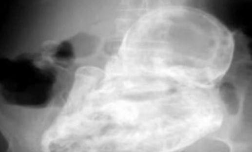 太吓人,82岁老太太查出竟怀孕40年